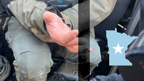 HSI Officer’s Finger Bitten Off by Anti-ICE Rioter in Minneapolis Chaos