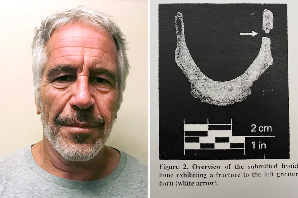 epstein-broken-bones-02